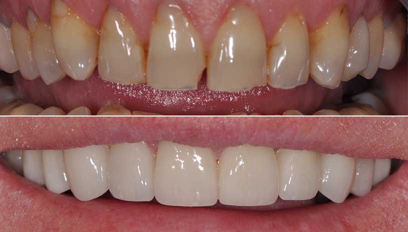 before and after smile from Carefree Smiles Dentistry