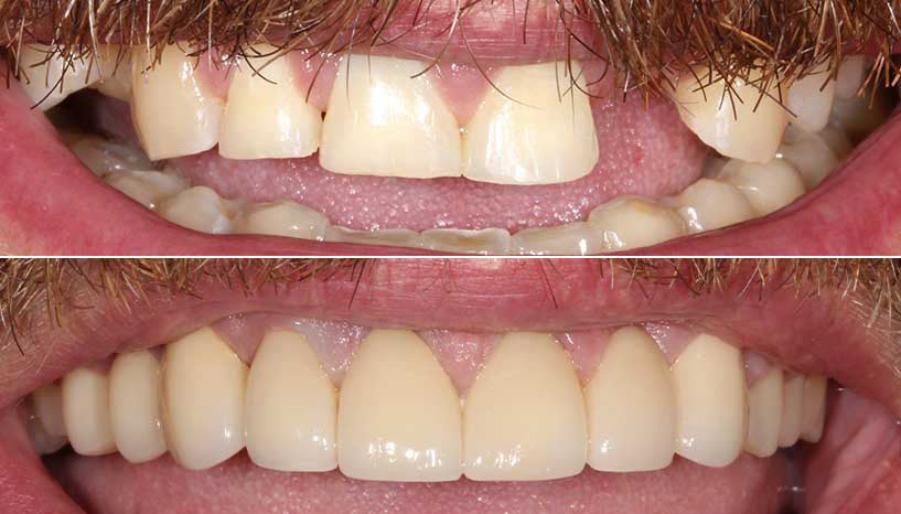 before and after smile from Carefree Smiles Dentistry