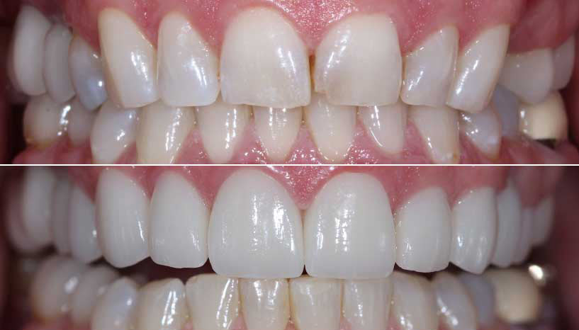 before and after smile from Carefree Smiles Dentistry