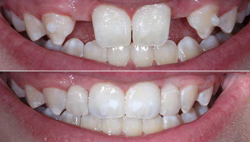 before and after smile from Carefree Smiles Dentistry