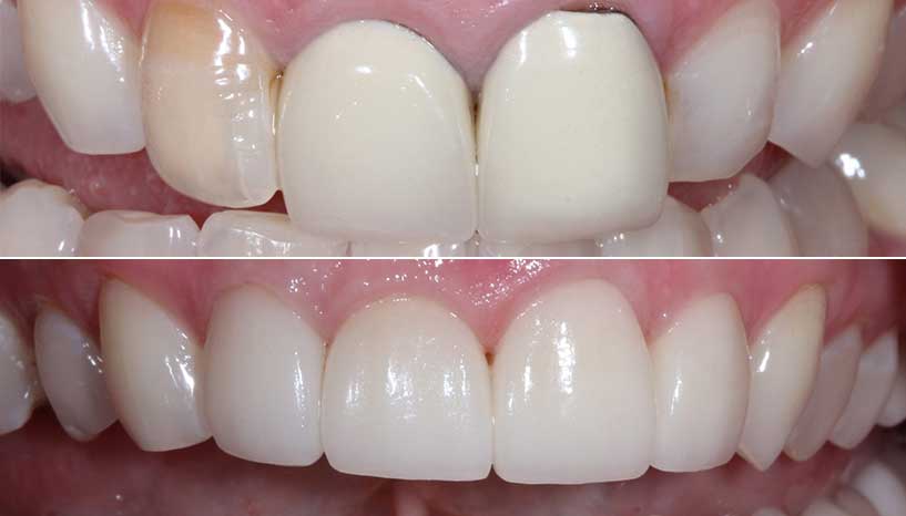 before and after smile from Carefree Smiles Dentistry