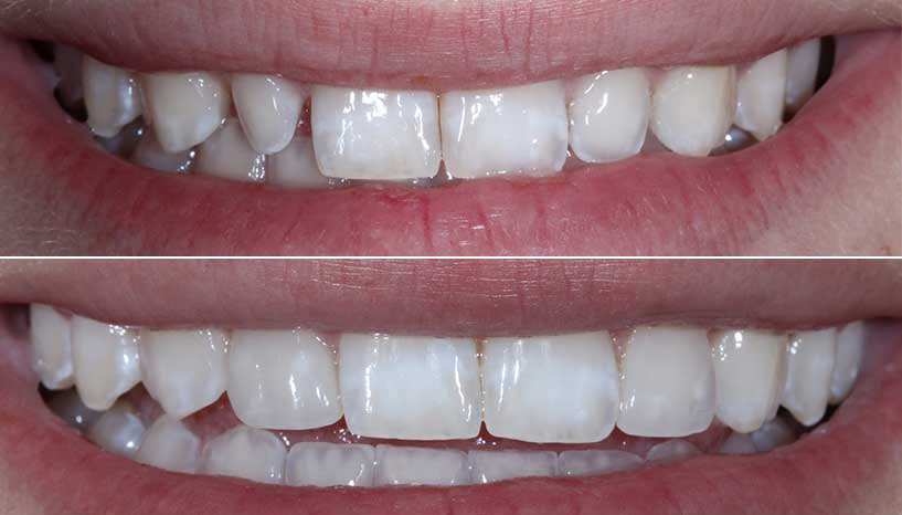 before and after smile from Carefree Smiles Dentistry