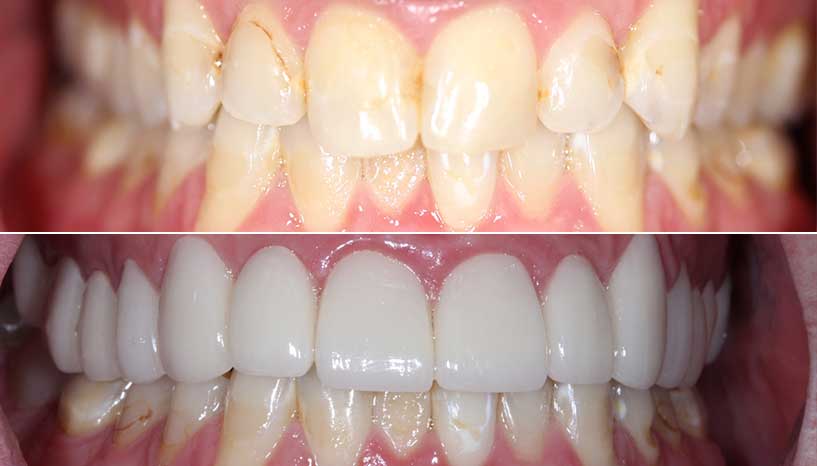 before and after smile from Carefree Smiles Dentistry
