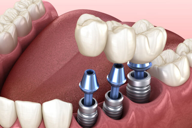dental implants in Phoenix