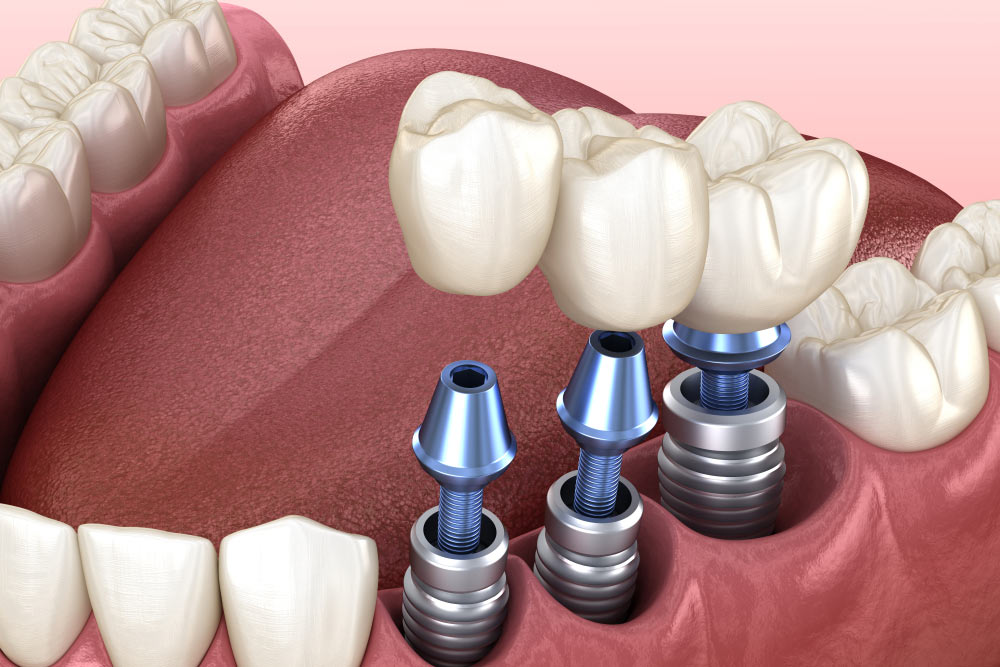 dental implants in Phoenix