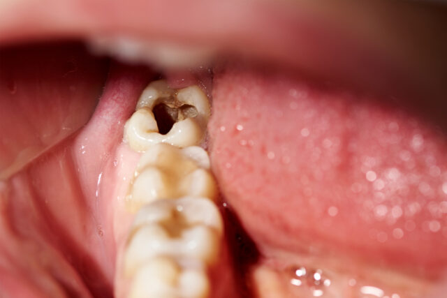 cavities