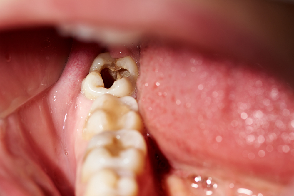 cavities